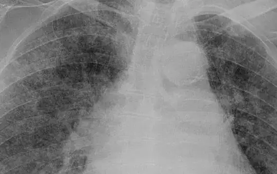 tuberculosis-wikimedia-1200jpg