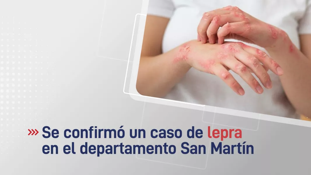 101623-se-confirmo-un-caso-de-lepra-en-el-departamento-san-martin