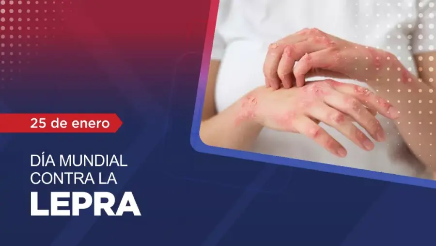 105976-el-domingo-se-conmemora-el-dia-mundial-de-la-lucha-contra-la-lepra